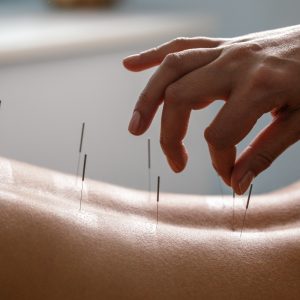 Acupuncture specialist inserting needle into patient's back due treatment. She is stimulating energy flow through the body for faster relaxation and recovery.